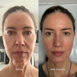 deep plane facelift vip