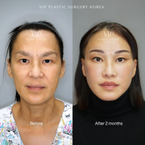 facial rejuvenation vip