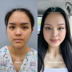 asian rhinoplasty before after