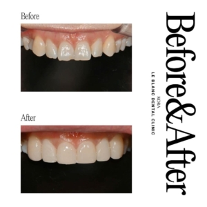 Le Blanc Dental Clinic_Dental veneers 2