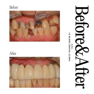 Le Blanc Dental Clinic_Dental implant surgery 2