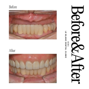 Le Blanc Dental Clinic_Dental implant surgery 3