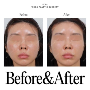 WOOA Plastic Surgery & Dermatology_Skin booster injections 2