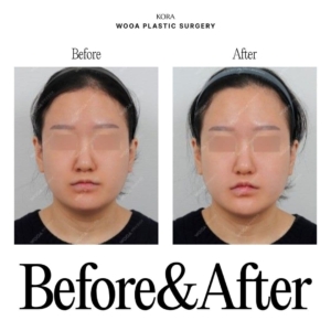 WOOA Plastic Surgery & Dermatology_Skin booster injections 4