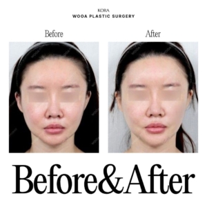 WOOA Plastic Surgery & Dermatology_Skin booster injections 7