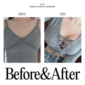 WOOA Plastic Surgery & Dermatology_Breast Augmentation 1