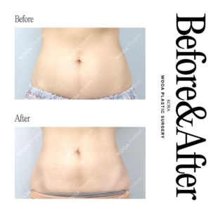 WOOA Plastic Surgery & Dermatology_Body liposuction