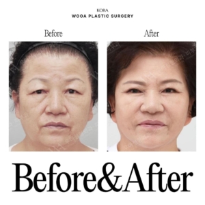 WOOA Plastic Surgery & Dermatology_Deep plane facelift & Neck lift 1
