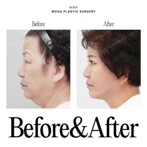 WOOA Plastic Surgery & Dermatology_Deep plane facelift & Neck lift 1 side view wooa