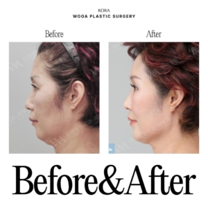 WOOA Plastic Surgery & Dermatology_Deep plane facelift & Neck lift 2 side view