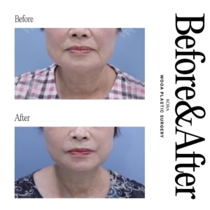 WOOA Plastic Surgery & Dermatology_Deep plane facelift & Neck lift 3