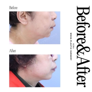 WOOA Plastic Surgery & Dermatology_Deep plane facelift & Neck lift 4 side view