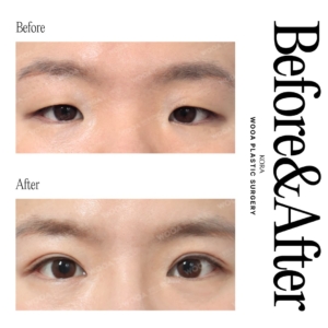 WOOA Plastic Surgery & Dermatology_Eye surgery
