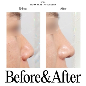 WOOA Plastic Surgery & Dermatology_Rhinoplasty 1