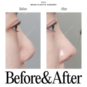 WOOA Plastic Surgery & Dermatology_Rhinoplasty 2.