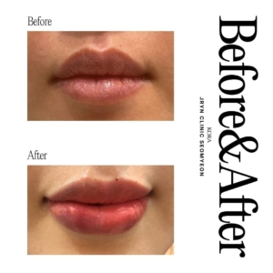 JRYN Clinic Seomyeon_Lip filler 2