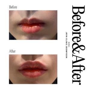 JRYN Clinic Seomyeon_Lip filler 3