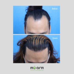 hair transplant before after