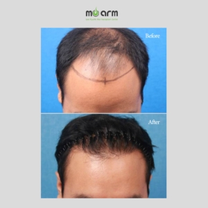 FUE hair transplant