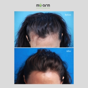 hair transplant before after