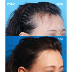 woman hair transplant korea