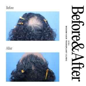 Moarm Hair Transplant Clinic_Hair Transplant on Scar