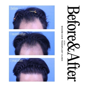Moarm's FUE hair transplant 2