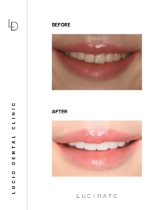 veneer before after4