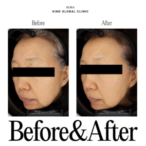 Dark Spot Removal (PicoCare)_1