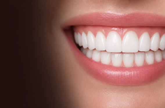 dental veneers