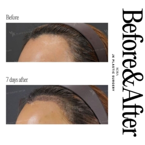 JK Plastic Surgery_ Hair loss treatment 1