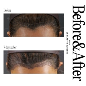JK Plastic Surgery_ Hair loss treatment 2