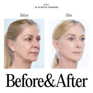 JK Plastic Surgery_Anti-aging surgery 7-2