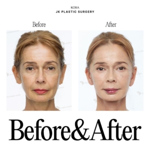 JK Plastic Surgery_Anti-aging surgery 8