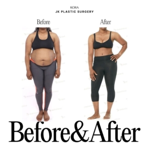 JK Plastic Surgery_Body liposuction, Tummy tuck 3