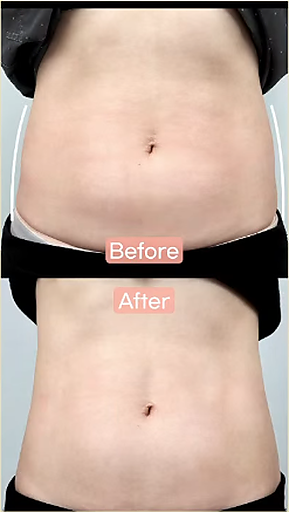 ONDA before and after body contouring result