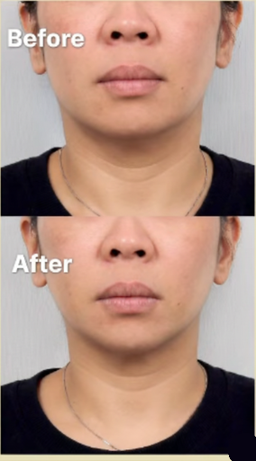 ONDA before and after face contouring result