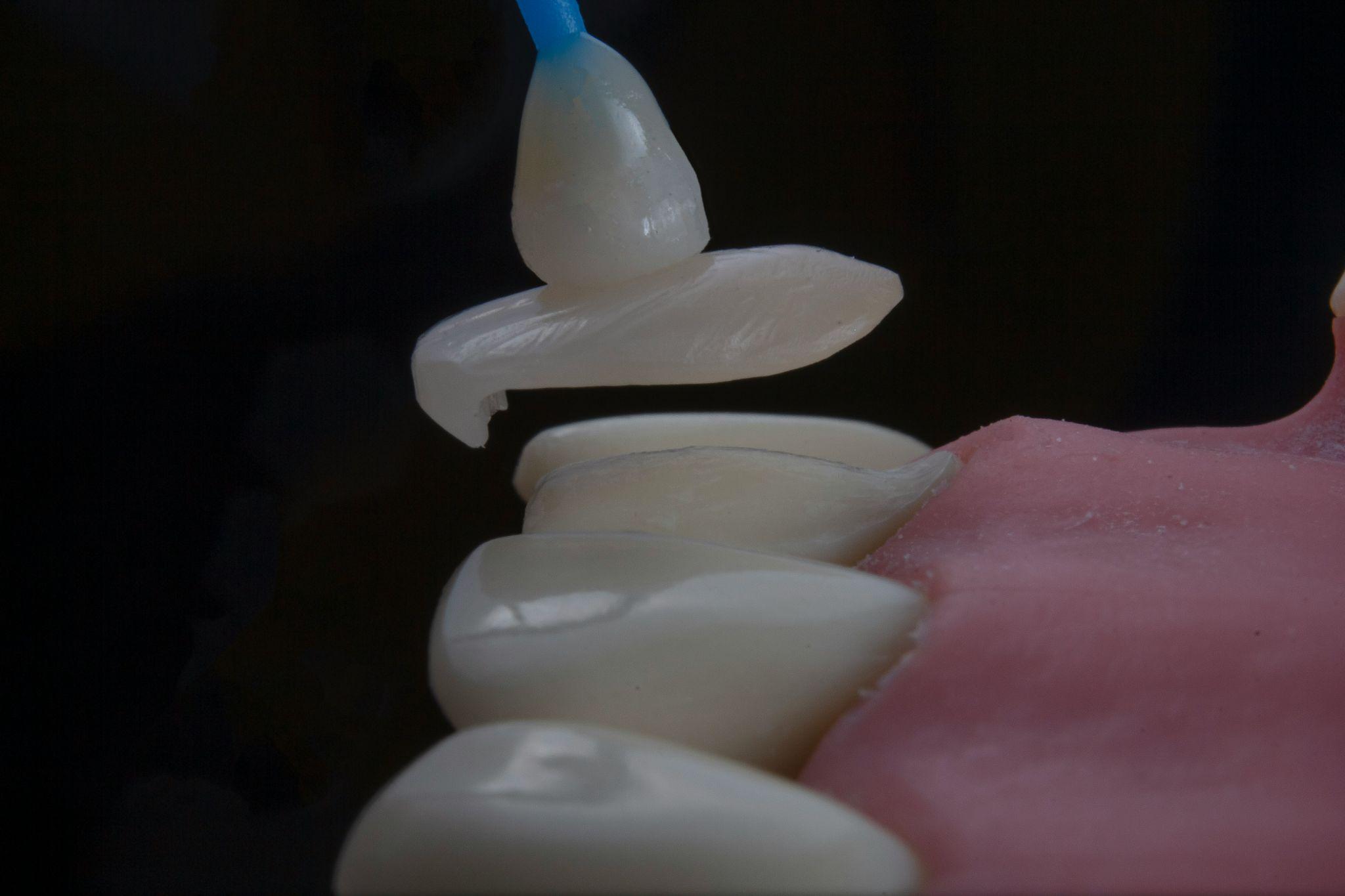 Veneer bonding closeup
