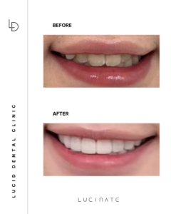 veneer before after5
