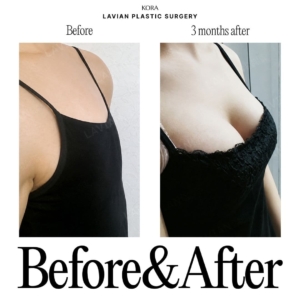 Lavian Plastic Surgery_Breast augmentation 1