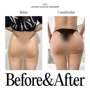Lavian Plastic Surgery_Buttock fat grafting 1
