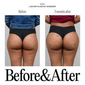 Lavian Plastic Surgery_Buttock fat grafting 2