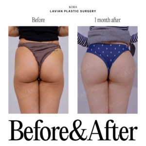 Lavian Plastic Surgery_Buttock fat grafting 6