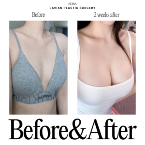Lavian Plastic Surgery_Breast augmentation 3