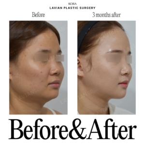 Lavian Plastic Surgery_Facial Contouring Surgery 2