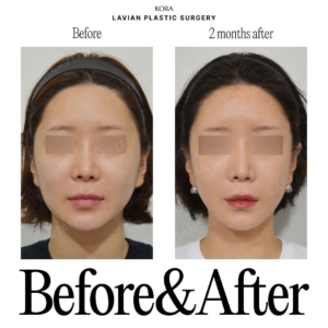 Lavian Plastic Surgery_Facial Contouring Surgery 4