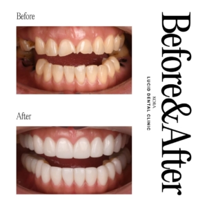 Dental prosthetics, Dental implants 2