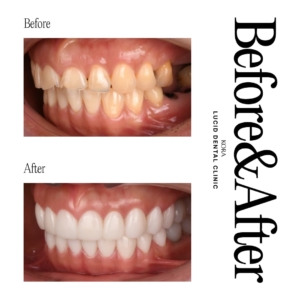 Dental prosthetics, Dental implants 3