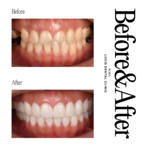 Dental prosthetics, Dental implants