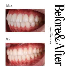 Dental retreatment 2